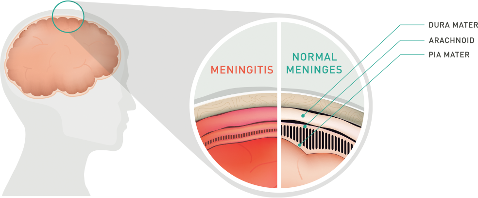 meningitis-illustration